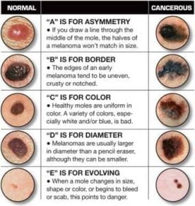 Save Your Skin From This Dangerous Disease How To Detect Skin Cancer   Moles And Birthmarks For Skin Cancer 285x300 